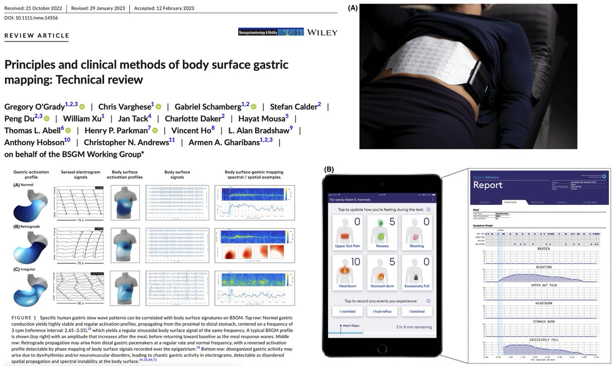 Rajan___Singh's tweet photo. #GastroparesisAwarenessMonth🔥
▶️Excellent technical Review @NGMJournal🚨
▶️So much learning about #ClinicalUtility of #BodySurfaceGastricMapping #BSGM in #GastroduodenalDisorders
✅Check out if you really wonder when #GastricEmptying does not always correlate with cardinal symptoms of #gastroparesis #FD & what to do next evaluating #SymptomCorrelations & #ClinicalOutcomes👏
@ANMSociety @esnm_eu #GITwitter
https://t.co/qVE3WTNpQ4