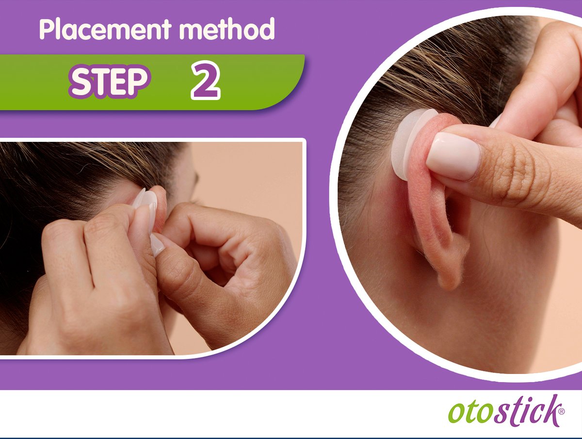 Determine the exact point where the corrector will be placed and simulate the Otostick effect before removing the protective papers from the adhesive. 

otostick.com

#Otostick #corrector #earcorrector #protrudingears #prominentears #beauty #cosmetics #aesthetics