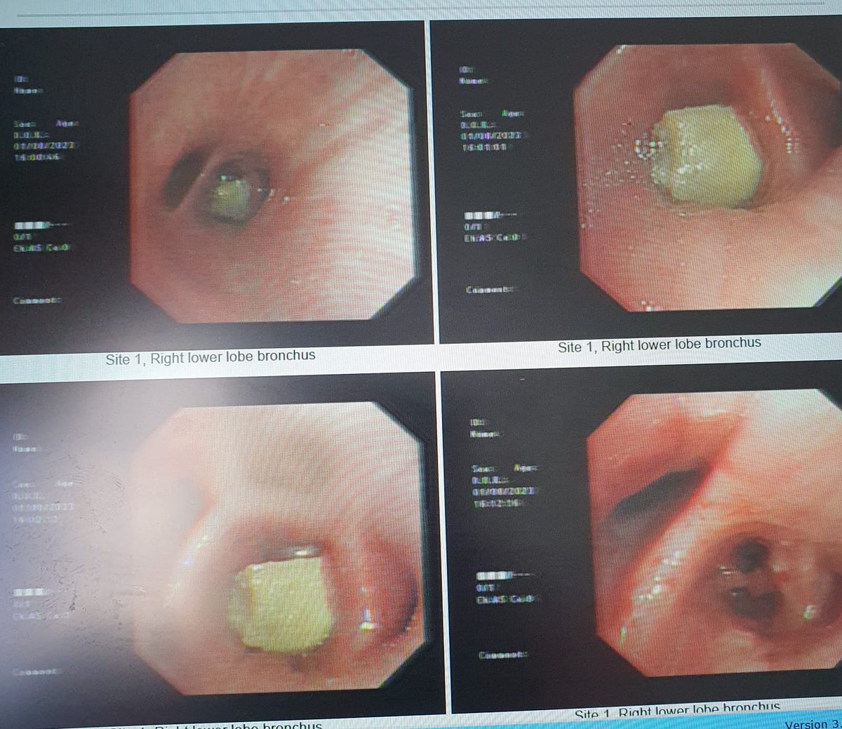 PaulMitchell68's tweet photo. A surreal outcome to my scheduled bronchoscopy at #ARI #Ward301 yesterday. Thanks to the outstanding skills of Senior Nurse Val Bruce &amp; team, not only was my legendary, 7 month old peanut found - it was extracted!🥜
....and finally.....breathe 😅🙏
#NHSGrampian @AberdeenLungs https://t.co/ciO8mc70t7