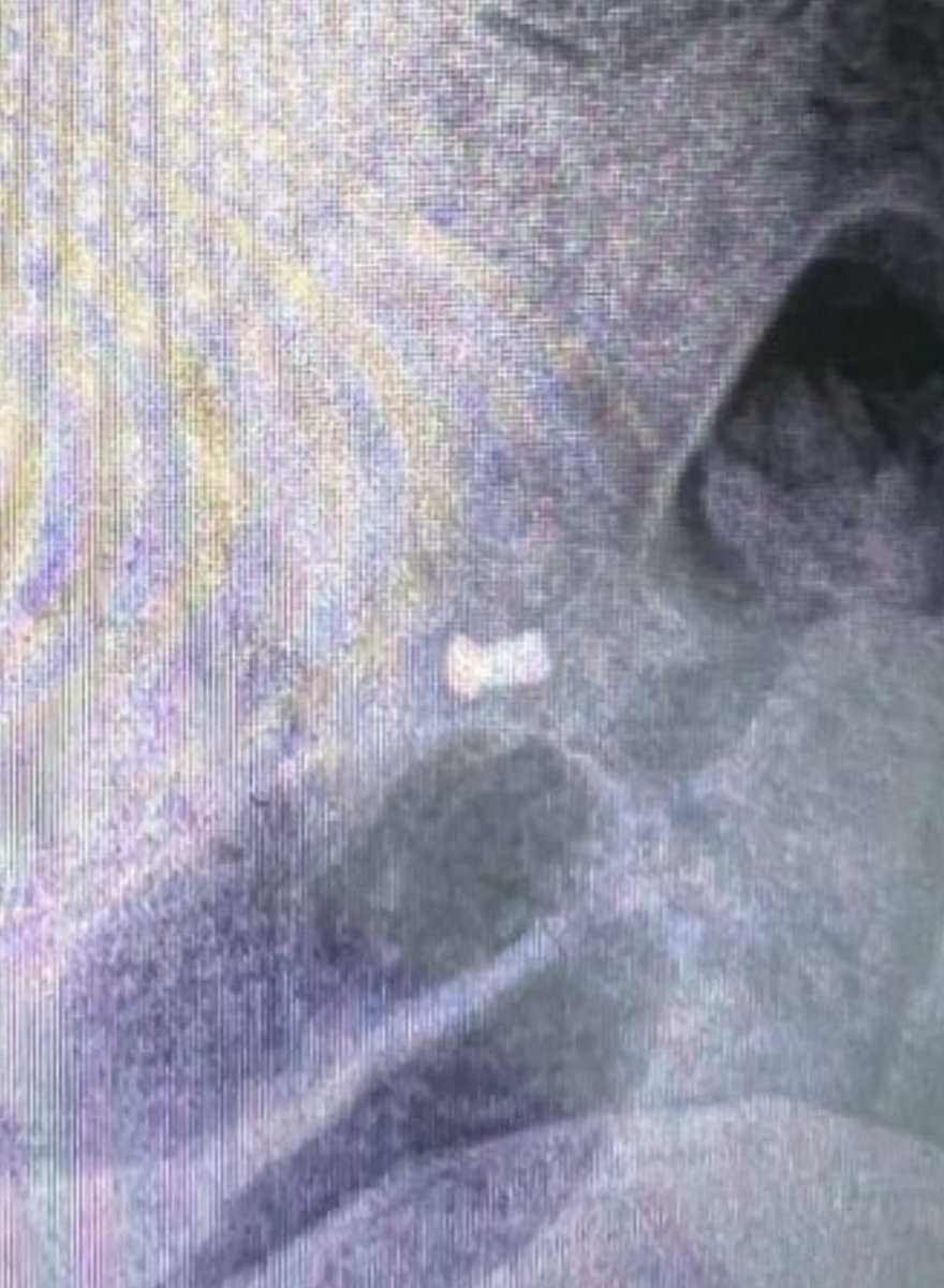 floridasoldat's tweet image. Update: shell impacted near me, tossed me a few feet into a crater and I landed knee-first on a brick, knee probably fractured. Got up to keep moving and a mortar landed next to me, threw a piece of shrapnel into the small of my back and tossed me into another crater. Shrapnel…