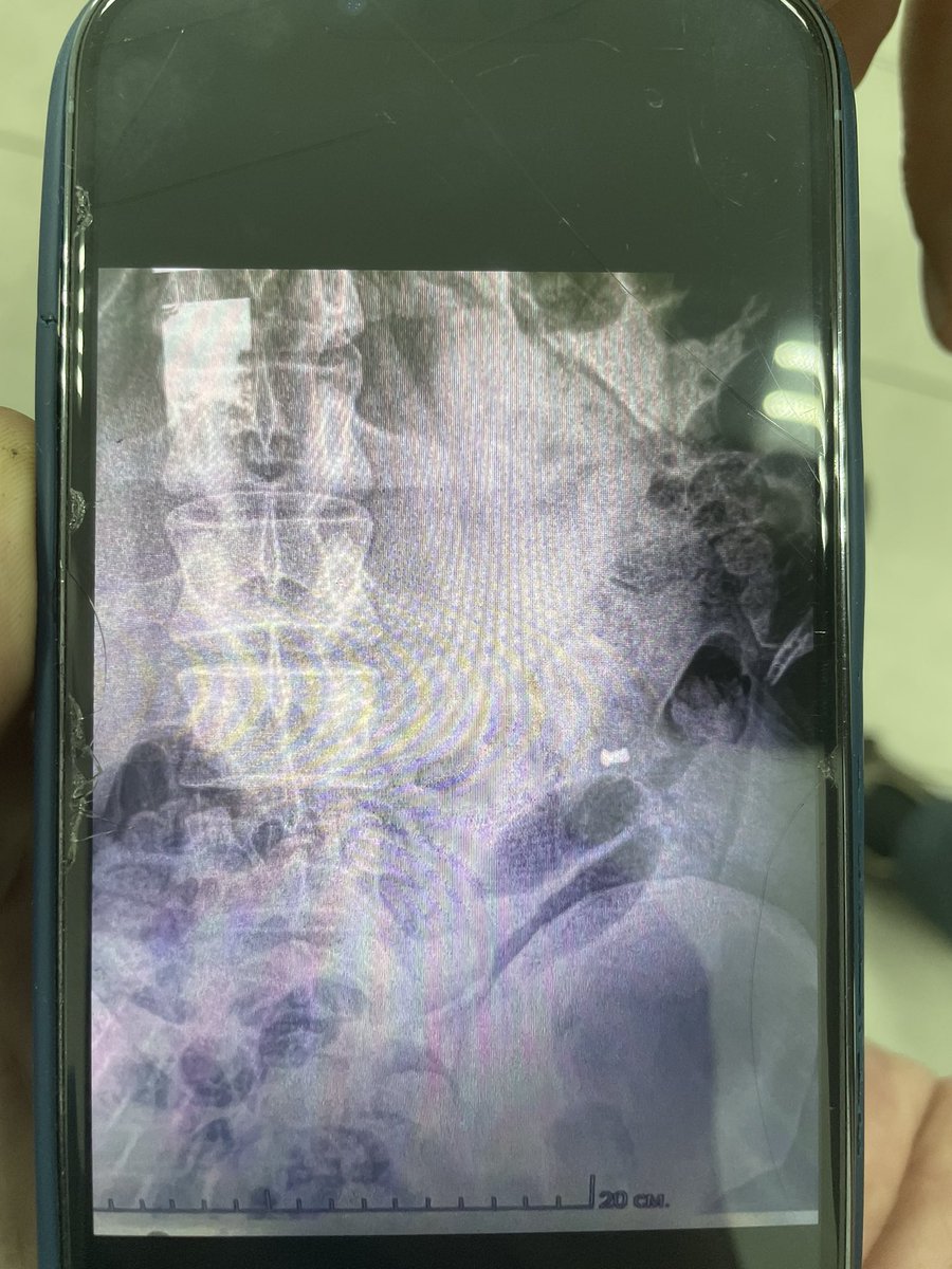 floridasoldat's tweet image. Update: shell impacted near me, tossed me a few feet into a crater and I landed knee-first on a brick, knee probably fractured. Got up to keep moving and a mortar landed next to me, threw a piece of shrapnel into the small of my back and tossed me into another crater. Shrapnel…