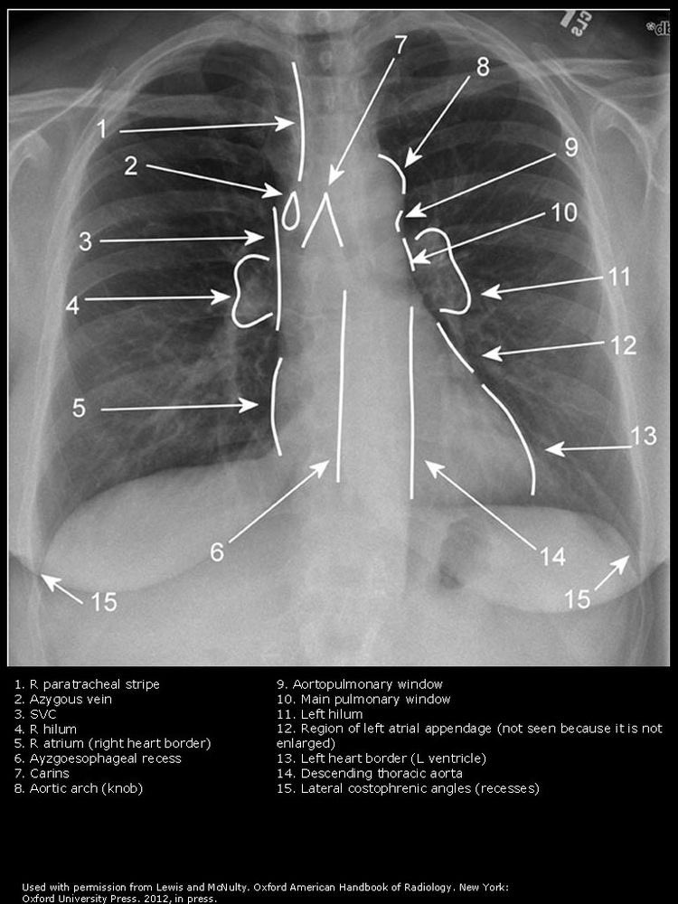OGdukeneurosurg's tweet photo. Basics anatomy seen on chest X-ray from Lewis and McNulty https://t.co/W0fAPi7YCG