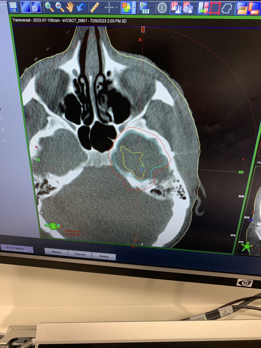 Landmark day 4 me today: half way through daily radiotherapy course (3 weeks to go)! CT scan images mapping my radiotherapy field show how precisely targeted it is (highest dose in yellow circle, less in blue, least in red: like contour lines on a map!).