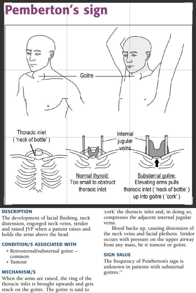 pgMedicine's tweet photo. Pemberton's sign
Description 
Associations 
&amp;
Mechanism

For regular uploads of valuable medical videos
Subscribe 👇
https://t.co/eo0l4HoS9t https://t.co/0Riub1oAP2