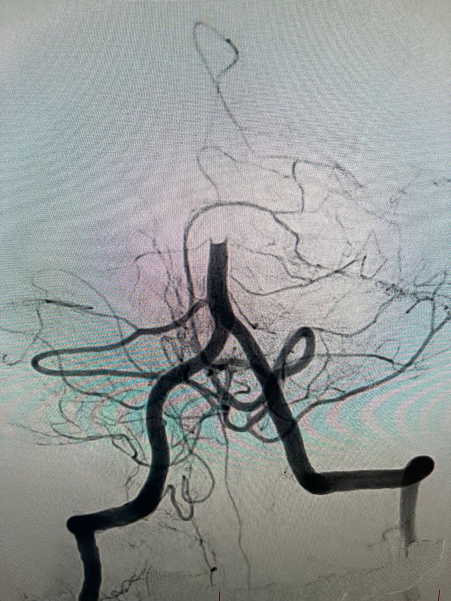 PenNeuro's tweet image. US HCPs: Radial access with #BMX81 through a tortuous arch to deliver #RED62 &amp;amp; #RED43 for acute basilar occlusion. First Pass recanalization. Courtesy of Dr. Agrawal in Las Vegas. Rx only. For risk info: bit.ly/2BYj7Yj Clinical results may vary