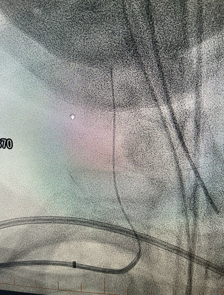 PenNeuro's tweet image. US HCPs: Radial access with #BMX81 through a tortuous arch to deliver #RED62 &amp;amp; #RED43 for acute basilar occlusion. First Pass recanalization. Courtesy of Dr. Agrawal in Las Vegas. Rx only. For risk info: bit.ly/2BYj7Yj Clinical results may vary