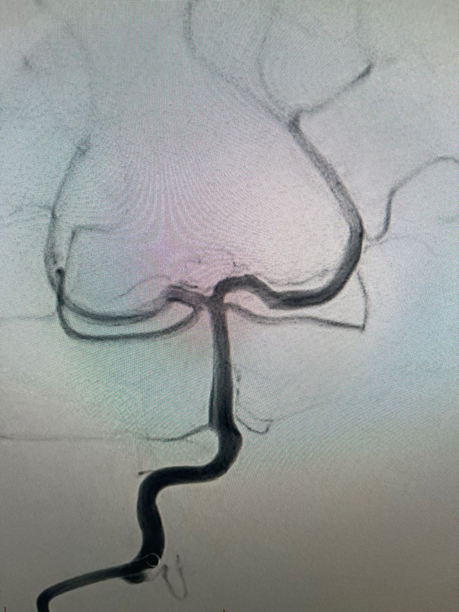 PenNeuro's tweet image. US HCPs: Radial access with #BMX81 through a tortuous arch to deliver #RED62 &amp;amp; #RED43 for acute basilar occlusion. First Pass recanalization. Courtesy of Dr. Agrawal in Las Vegas. Rx only. For risk info: bit.ly/2BYj7Yj Clinical results may vary