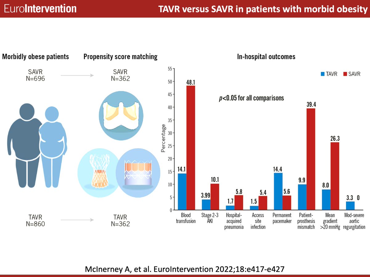 In this multicentre retrospective study of morbidly obese patients,  SAVR and TAVR offer similar mid-term outcomes in patients with severe aortic stenosis, however, TAVR offers some advantages in terms of periprocedural morbidity. ow.ly/JQhV50KiHXw