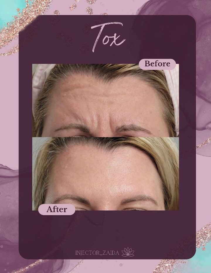 HealthTonicity's tweet photo. Tox for the win! Smooth out your facial lines with Xeomin this month for $10per unit. 
Treatment done by injector Zaida. 
#medspa #safetyharborspa #clearwater #injectables #beauty #xeomin https://t.co/ZbGIjySZ2z