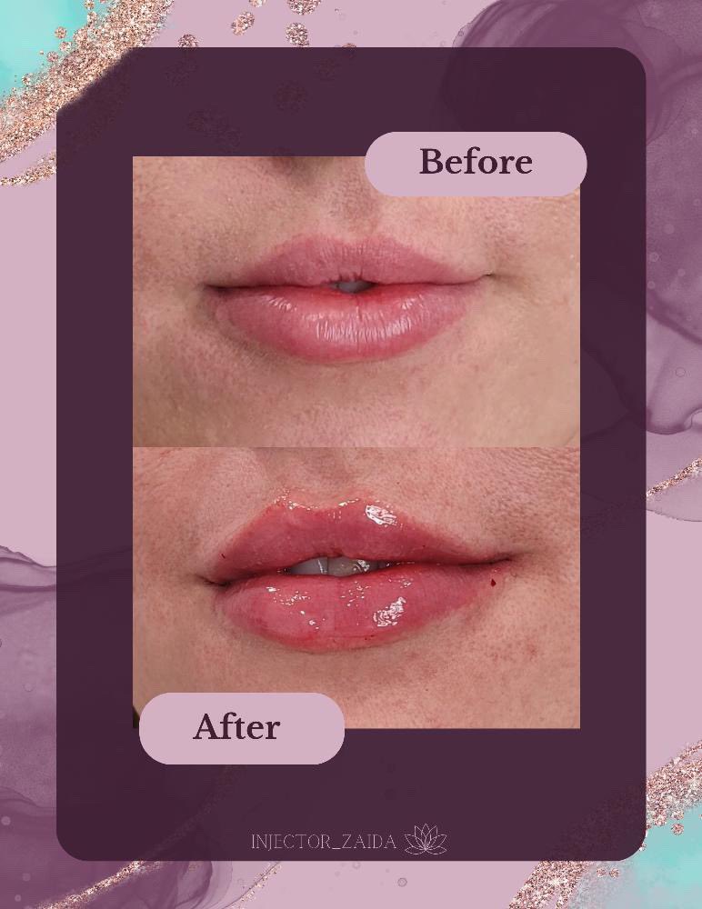 HealthTonicity's tweet photo. Tox for the win! Smooth out your facial lines with Xeomin this month for $10per unit. 
Treatment done by injector Zaida. 
#medspa #safetyharborspa #clearwater #injectables #beauty #xeomin https://t.co/ZbGIjySZ2z