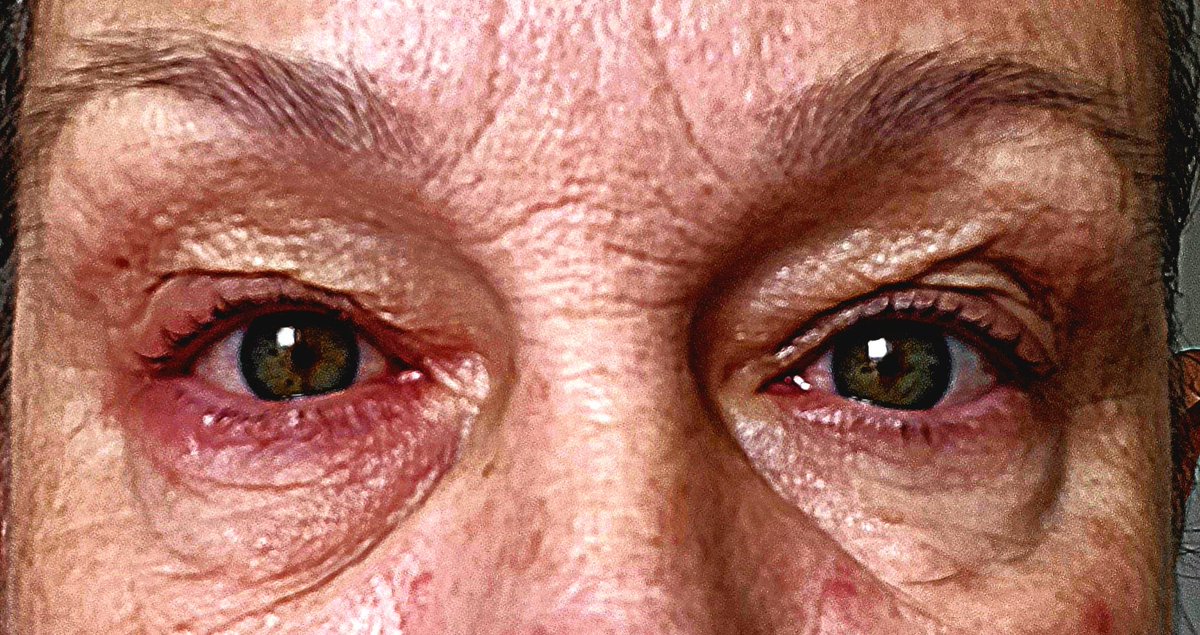 These are my eyes, sores all around, red, swollen, sores on skin, white mucus build up under skin, due to lymphatic system not working. Trying to tell #GP #NHS but been told once again it's nothing? #medical #sick #mysterysymptoms #helpless