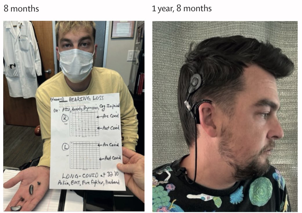 WesElyMD (@weselymd) on Twitter photo Real Suffering: Long COVID
We must do more to discover scientific answers & medical treatments for LONG-COVID
In our recent Neuro #LongCOVID paper in <a href="/LancetRespirMed/">The Lancet Respiratory Medicine</a>…read 🧵👇
We had permission to present the true story of this 32-year-old father, husband, firefighter, and Real Suffering: Long COVID
We must do more to discover scientific answers & medical treatments for LONG-COVID
In our recent Neuro #LongCOVID paper in <a href="/LancetRespirMed/">The Lancet Respiratory Medicine</a>…read 🧵👇
We had permission to present the true story of this 32-year-old father, husband, firefighter, and