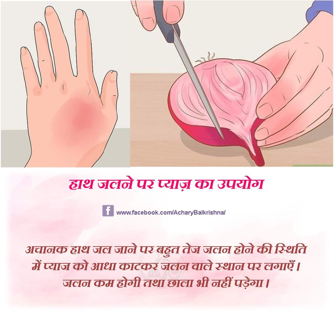 हाथ जलने पर प्याज़ का उपयोग