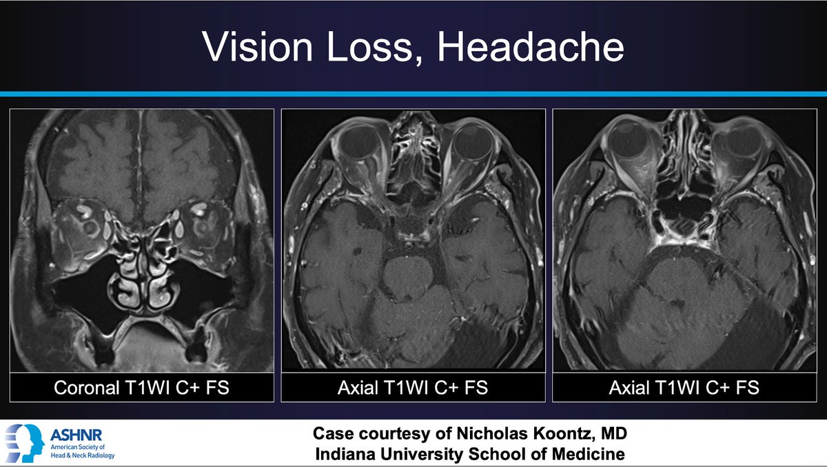 #ASHNRCOTW #223: Vision loss, headache. Dx? Thx @nakoontz @IURadiology 4 case! #ASHNR23 Answer w/ appropriate GIF only -- stay professional & don't spoil it! @AshokSrini15 @callyrobs @DShatzkes @CDP_Rad @rhwiggins @cmtomblinson @ESHNRSociety @WmOBrienDO @tabby_kennedy @RadRupa