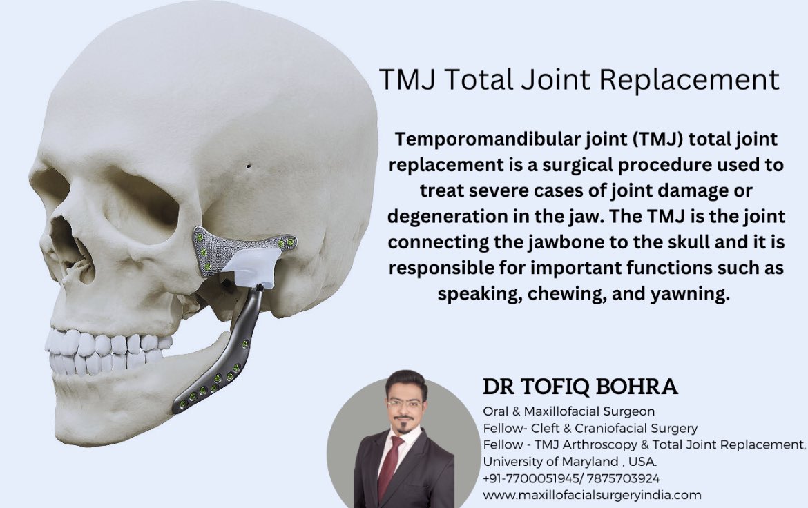 TofiqBohra_OMFS's tweet photo. #tmd #tmjreplacement #totaljointreplacement #tjr #oralandmaxillofacialsurgery @JArthroplasty @aomsiOfficial @ArthroscopyJ @ArthroToday @UTMB_OMFS @Don_Kewalramani #dentistry #tmj #tmjdoctor https://t.co/IjPZnMVI2n