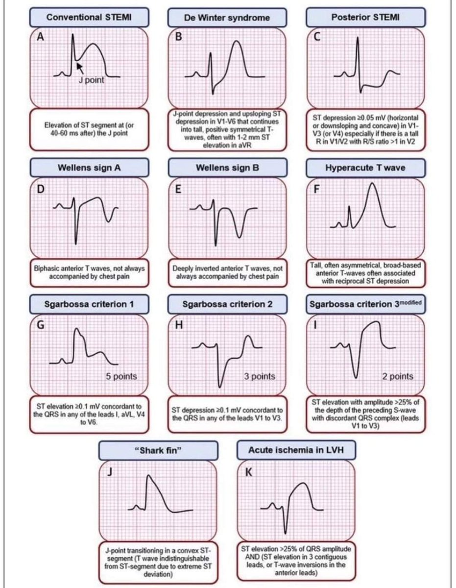 walinjom's tweet photo. High risk ECGs : https://t.co/YEfz93e19J