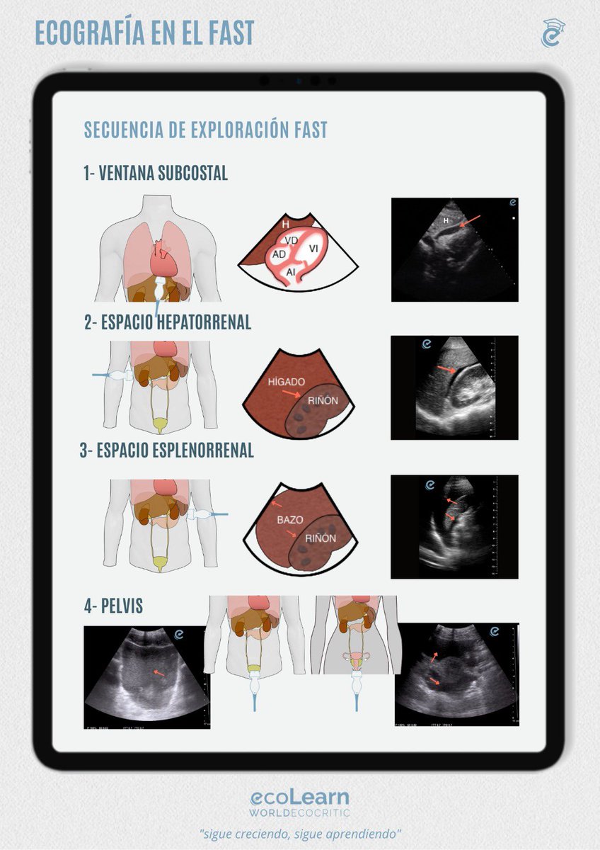 Secuencia de exploración en el FAST 🩻

Presentamos la secuencia de exploración ecográfica abdominal en situaciones de urgencia. Útil no solo en el paciente politraumatizado, sino en otras situaciones como en el postquirúrgico.