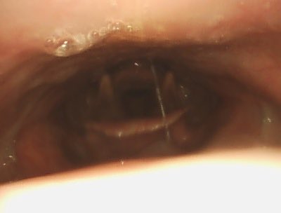 Long-term result of my personal technique of palatoplasty / expansion sphincterplasty for OSA.  Pt has mild nasopharyngeal reflux.  OSA is cured.  Also, he was found to have an incidental SCCA in one tonsil that was cured surgically at the same time.
#ENTX