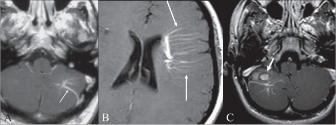 All 3 of these MRI images show the same abnormality in 3 different people.  Diagnosis?