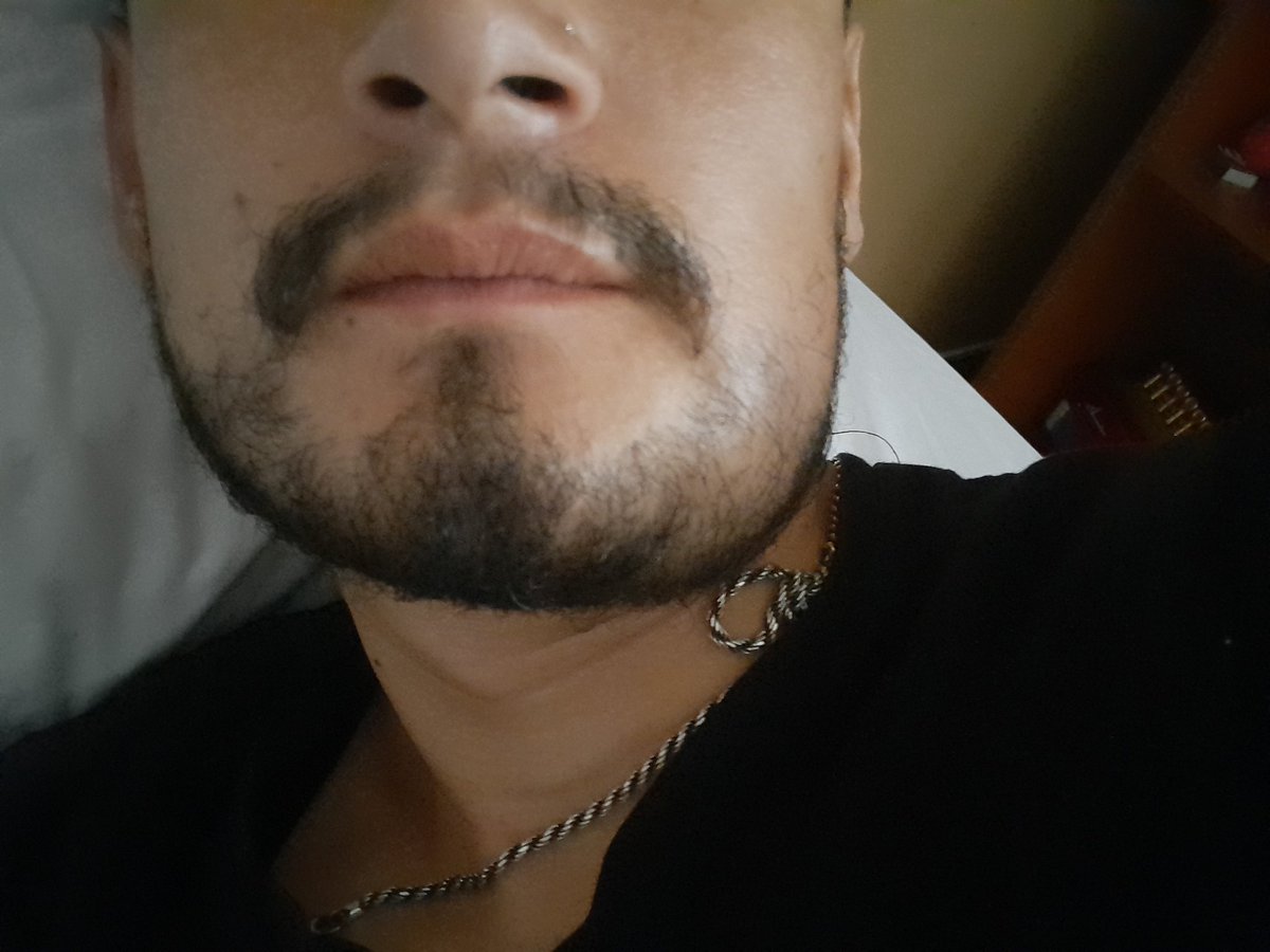 La cirugia de cordalas me dejo deforme 😕