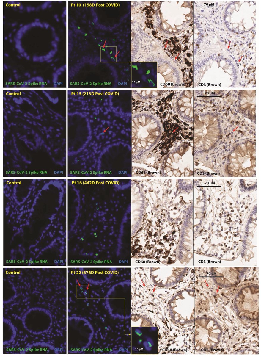 Although a small #LongCovid study, it's unique by doing whole-body PET T-cell imaging and GI tissue biopsies showing marked persistence (2+ years) of immune activation, and virus RNA, respectively, and some correlation with symptoms
medrxiv.org/content/10.110…