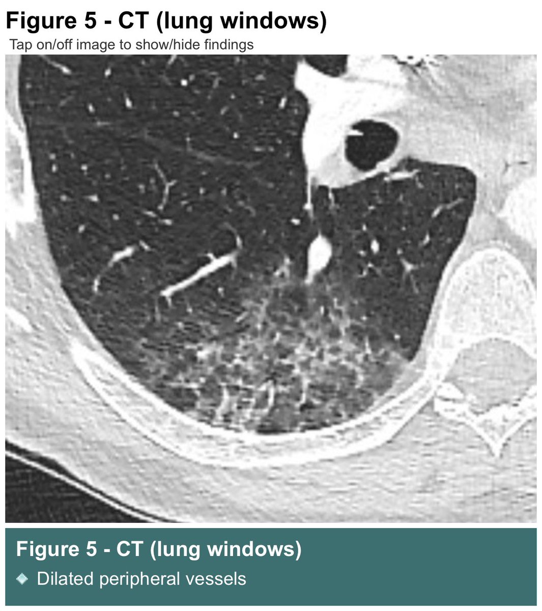 I’ll say it again

Dear medical colleagues who write about acute #COVID

Stop calling the lung disease ‘pneumonia’

It is not!

It is a pulmonary vasculopathy, a disease of the lung blood vessels

Pneumonia causes airways inflammation

COVID is the opposite of pneumonia!

Thanks
