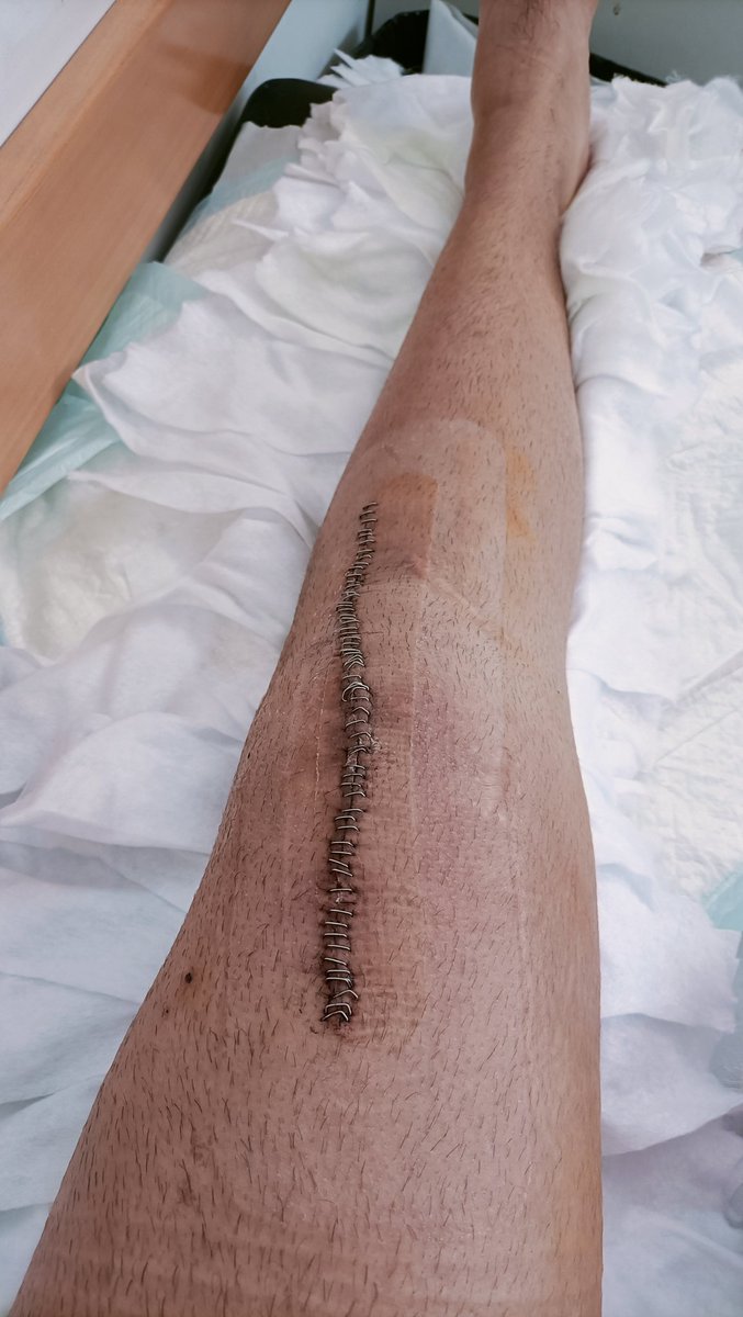 pau121978's tweet photo. Mi hijo un chico de 20 años operado el 20 d junio después de esperar desde el 2020, de una realineacion rotuliana con casi 70 grapas en su rodilla . El traumatólogo solicita rehabilitación con prioridad preferente, y llega la carta del sergas citándolo para el 21 de noviembre. https://t.co/f80qYMbM5h