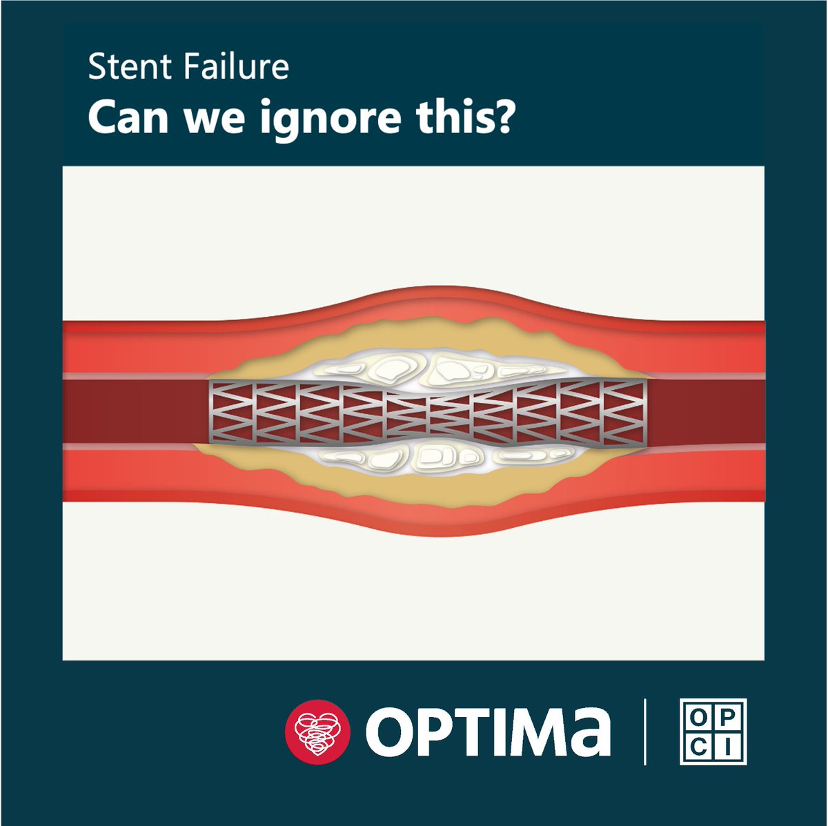 jcspratt's tweet photo. #OptimalPCIlondon explores important problems in #StentFailure, how to assess intravascular and extravascular. What are the treatment options, and what drives this choice?
Visualised talks, live case scenarios, and hands-on sims and discussions.
➡ https://t.co/I7fhLaJh0g https://t.co/0EbyofUz3p