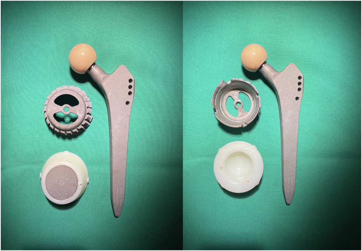 JArthroplasty's tweet photo. A straight rectangular cementless implant provides excellent implant survival and high patient satisfaction. However, survival rates of the whole total hip replacement system were reduced by a high revision rate due to wear-related problems.

https://t.co/kRiPBshbI6 https://t.co/39j166dJFv