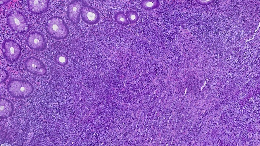 DraEosina's tweet photo. 🪱SYPHILITIC PROCTITIS🪱
🚩ALWAYS advise to rule out ITS in rectal chronic active proctitis! And remember: a negative Treponema stain is not enough.
😮Can mimic CANCER or IBD but it is benign &amp; easily treated.
📋https://t.co/mdvDHMHZY4
#GiPath #Pathology https://t.co/9UoDM3AmMO