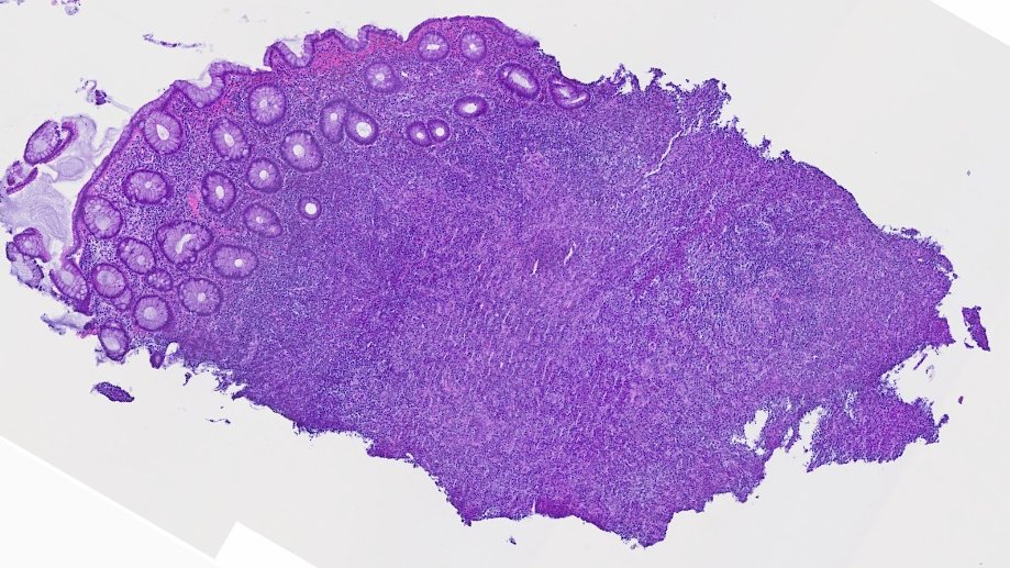 DraEosina's tweet photo. 🪱SYPHILITIC PROCTITIS🪱
🚩ALWAYS advise to rule out ITS in rectal chronic active proctitis! And remember: a negative Treponema stain is not enough.
😮Can mimic CANCER or IBD but it is benign &amp; easily treated.
📋https://t.co/mdvDHMHZY4
#GiPath #Pathology https://t.co/9UoDM3AmMO