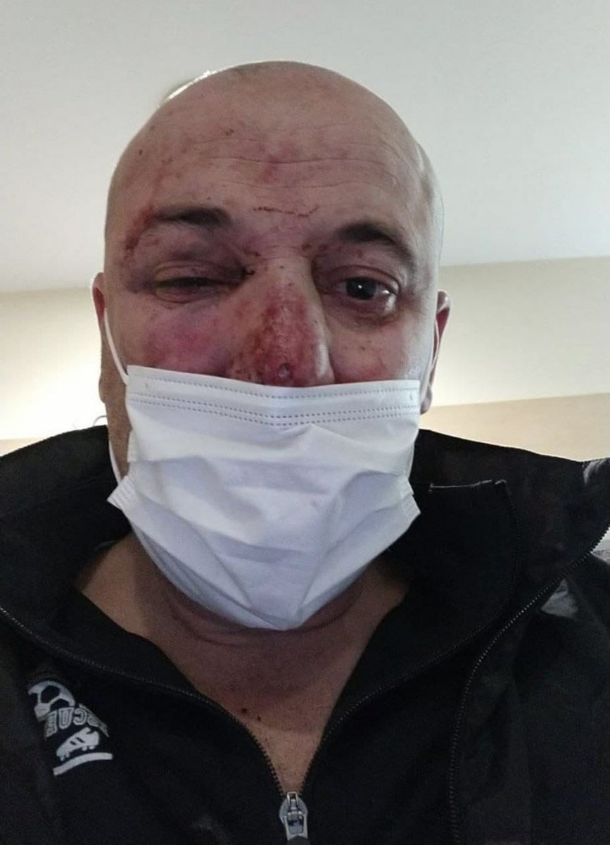 FonsiLoaiza's tweet photo. Estos policías ultraderechistas se llaman José Luis Pedregosa y Manuel Fernández y hace 2 años agredieron brutalmente a un padre y su hija menor en Linares. Continúan en el cuerpo. En septiembre serán juzgados. Así dejaron al padre. La víctima también será juzgada por defenderse. https://t.co/s6XqlUAb2C