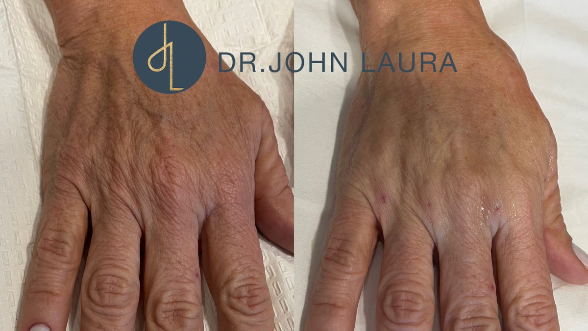 DrJohn_Laura's tweet photo. Did you know one of the many uses of Bio-filler is hand rejuvenation? The results in this patient’s hand speak for themselves! Learn more about this amazing treatment:
https://t.co/px4bfizRRJ
#biofiller #skinrejuventaion https://t.co/YsaHwsr8Ir