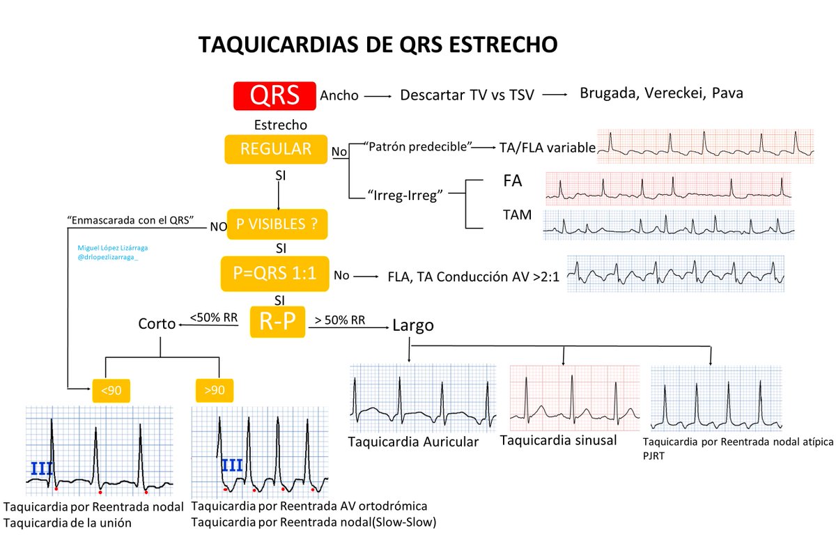 LopezLizarraga_'s tweet photo. Algoritmo visual del diagnóstico diferencial en las #taquicardias de #QRS estrecho. 🫀⚡️

#FOAMed #ECG 
@DanielSierraLM @JL_MoralesArt @EkgHacks @Arritmias_H12O @falsapelirroja @the_cardiomedic https://t.co/5Gt3J0Tyfl