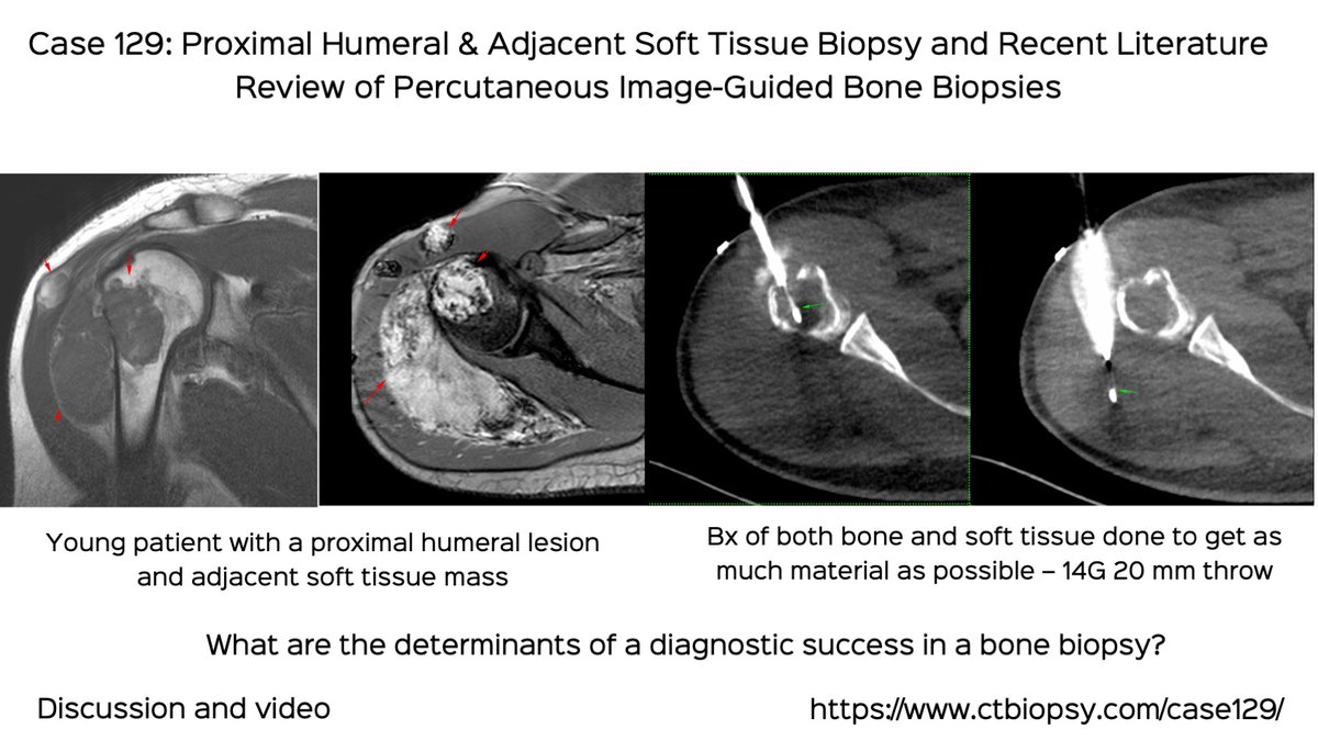 bhavinj's tweet photo. Case 129: Proximal Humerus & Adjacent Soft Tissue Biopsy (Bone & Soft Tissue) with Recent Literature Review of Bone Biopsies
How to increase diagnostic yield
Discussion video
https://t.co/dukXNEpF6C
#ctbiopsy #irrad #bonebiopsy #chondrosarcoma #mesenchymalchondrosarcoma https://t.co/pdP08xNsZt