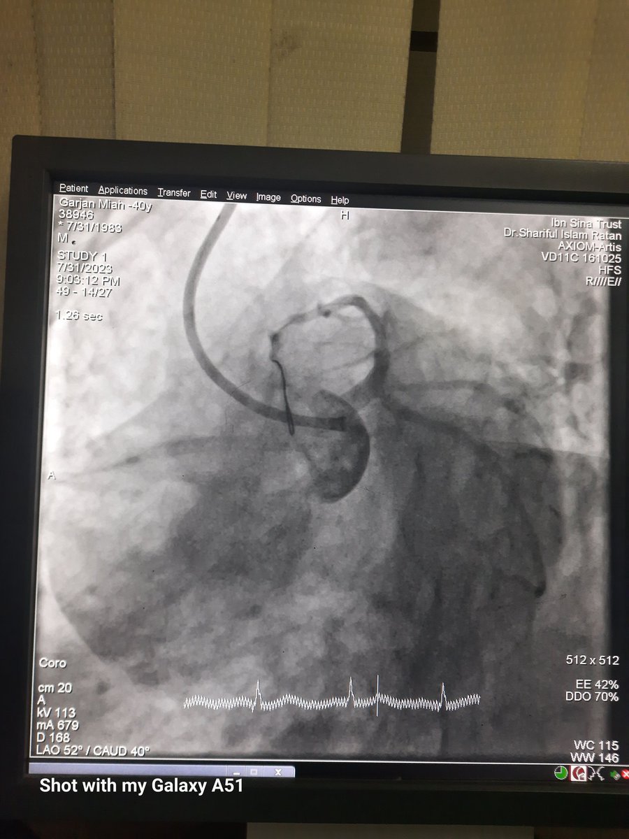 Card_Shariful's tweet photo. I have done it Successfully with IVUS 
@radcliffeCARDIO
 @conceptmedicals 
@medshronline 
@summitmd_cvrf 
#InterventionCardiologist
#EuroIntervention https://t.co/9R7Dzomrtl