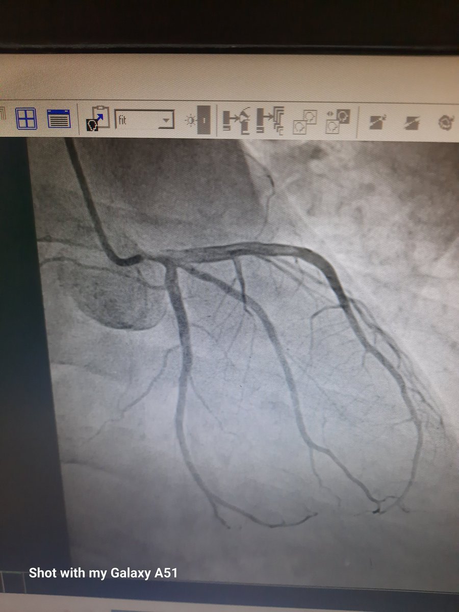 Card_Shariful's tweet photo. I have done it Successfully with IVUS 
@radcliffeCARDIO
 @conceptmedicals 
@medshronline 
@summitmd_cvrf 
#InterventionCardiologist
#EuroIntervention https://t.co/9R7Dzomrtl