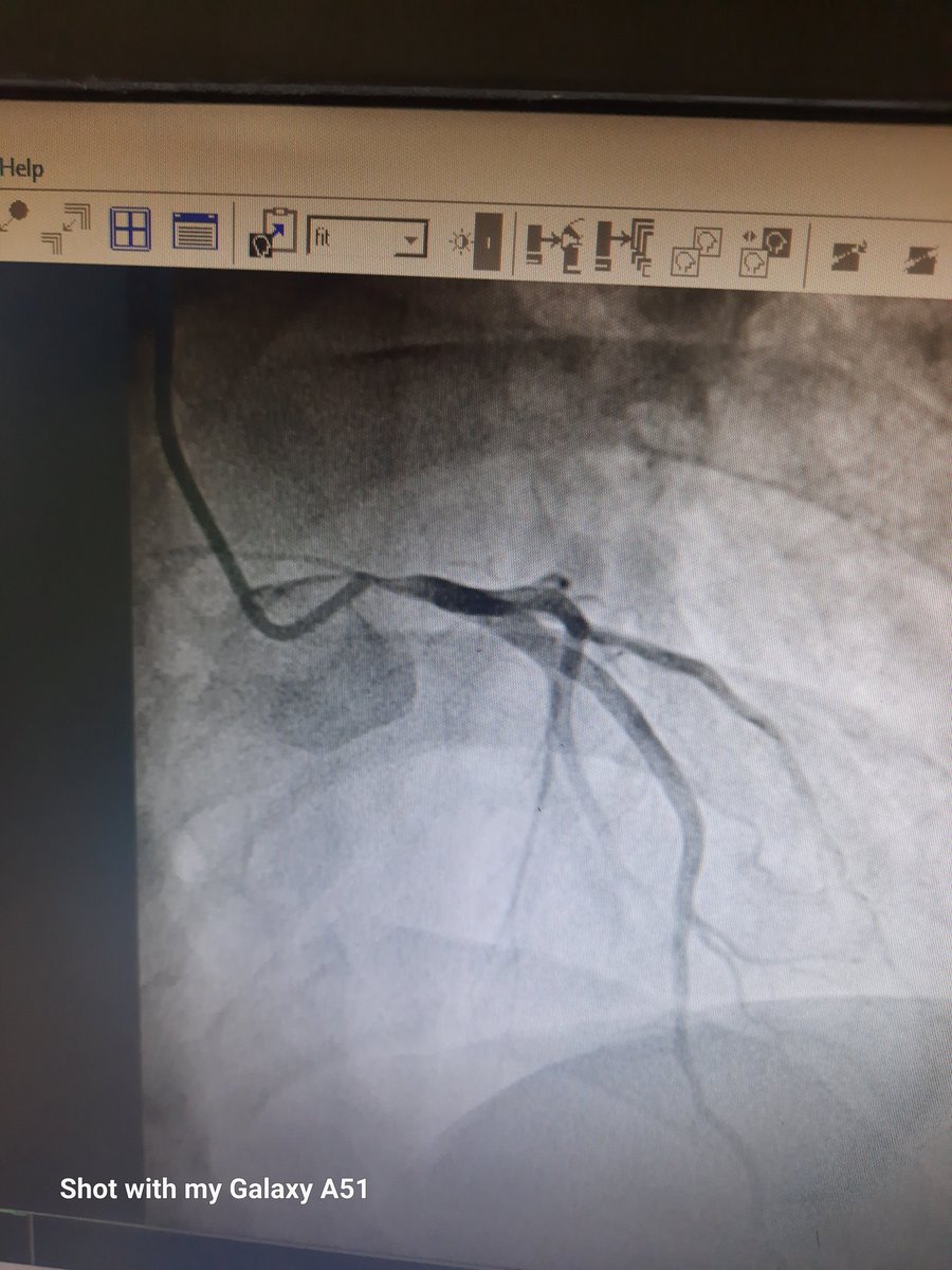 Card_Shariful's tweet photo. I have done it Successfully with IVUS 
@radcliffeCARDIO
 @conceptmedicals 
@medshronline 
@summitmd_cvrf 
#InterventionCardiologist
#EuroIntervention https://t.co/9R7Dzomrtl