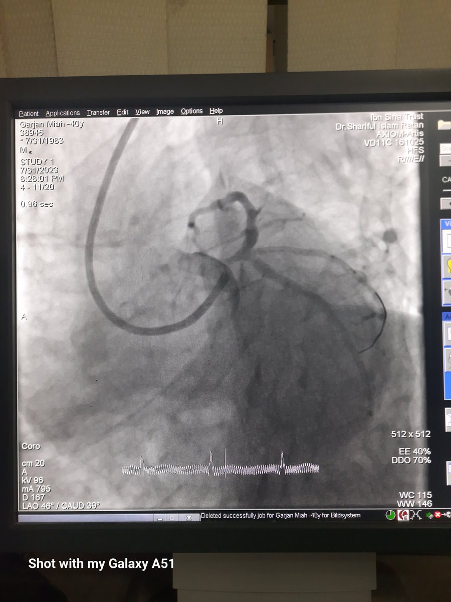 Card_Shariful's tweet photo. I have done it Successfully with IVUS 
@radcliffeCARDIO
 @conceptmedicals 
@medshronline 
@summitmd_cvrf 
#InterventionCardiologist
#EuroIntervention https://t.co/9R7Dzomrtl