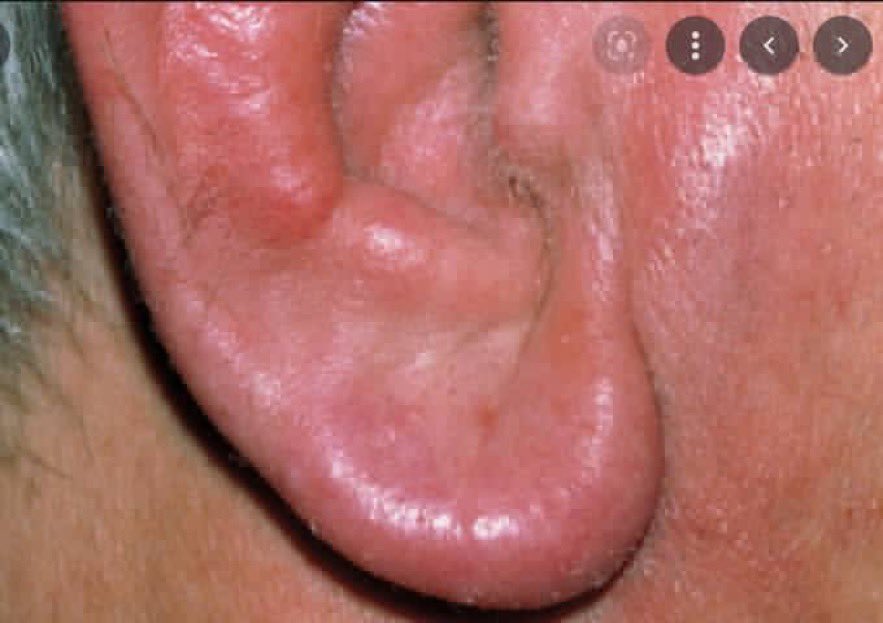BrownJHM's tweet photo. A middle aged male presented with high grade fever, pancytopenia, painful ears &amp; joints &amp; acute hypoxic respiratory failure. HLH was ruled out. What is the likely diagnosis? #Medtwitter https://t.co/tv1u6Gq8fz