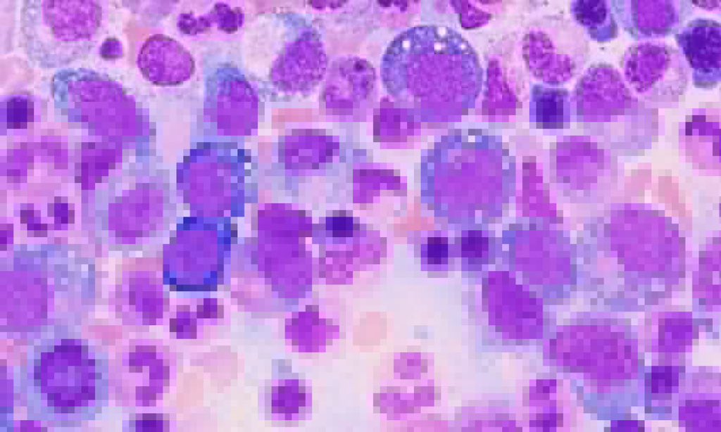 BrownJHM's tweet photo. A middle aged male presented with high grade fever, pancytopenia, painful ears &amp; joints &amp; acute hypoxic respiratory failure. HLH was ruled out. What is the likely diagnosis? #Medtwitter https://t.co/tv1u6Gq8fz