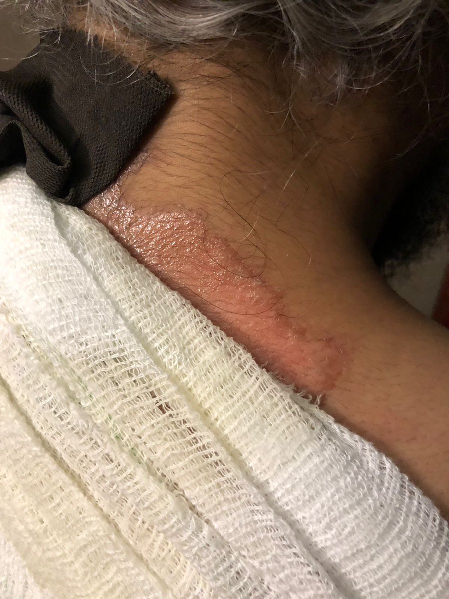 SLEWDADA's tweet photo. Don’t play with boiling water fam ! Somebody pray for me ! The pain ! https://t.co/LJ82VmtyyJ