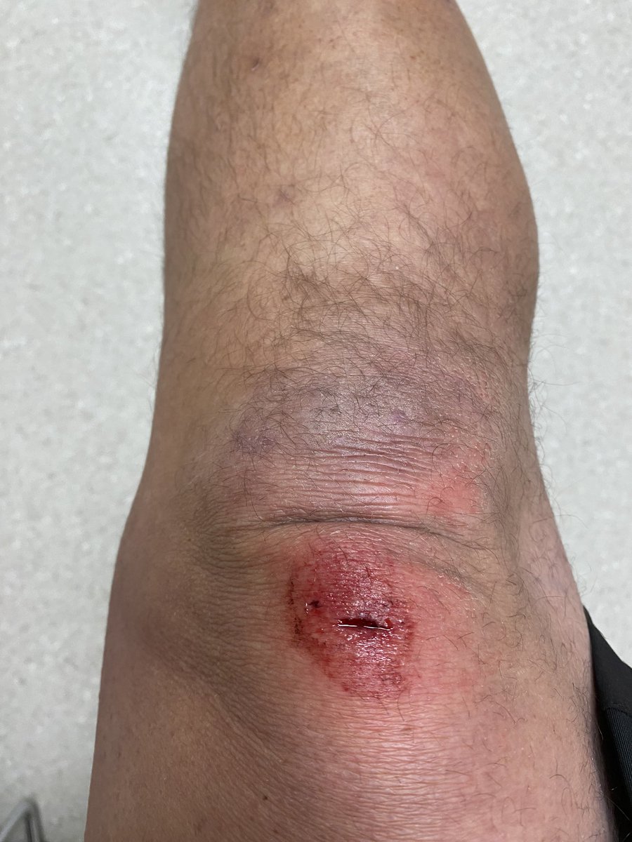 dan1968freenet1's tweet photo. Abflug mit dem MTB bei Dunkelheit.
Dumm gelaufen 🙃🙁😎
Nichts gebrochen nur Prellungen (Knie, Ellenbogen und die Rippen) https://t.co/PssU3YR7hs