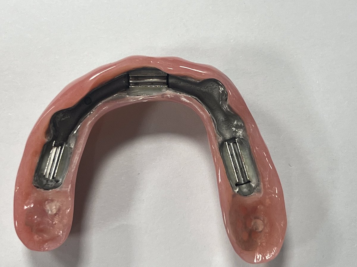 CosmosDentalCN's tweet image. Titanium-bar with overdenture

made by Cosmos Dental Technology

#overdenture #implant #titaniumbar #denture #dental