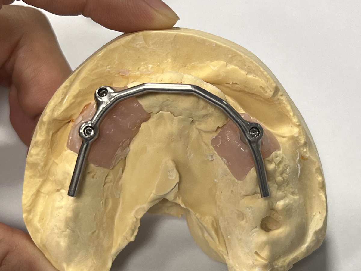 CosmosDentalCN's tweet image. Titanium-bar with overdenture

made by Cosmos Dental Technology

#overdenture #implant #titaniumbar #denture #dental