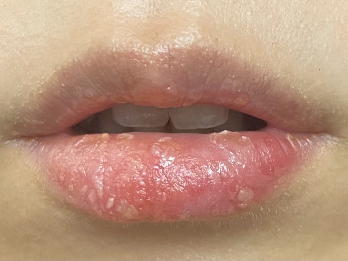 YesmiiOl's tweet photo. 昨日から一転、なんだかとても調子悪い。。剥けるのは薄いんだけど、剥けちゃいけない皮が剥けてるかんじ、、そして下唇の下の縁が一番薄くなっててジンジンする。そこだけ剥けた直後血管の点々見えるし、、こんなの前の時あったかな🫠 https://t.co/VSdLUSiVSn