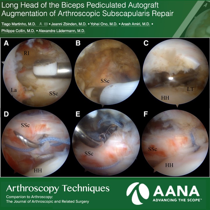 Long Head of the Biceps Pediculated Autograft Augmentation of Arthroscopic Subscapularis Repair ow.ly/6OnT50PocTr