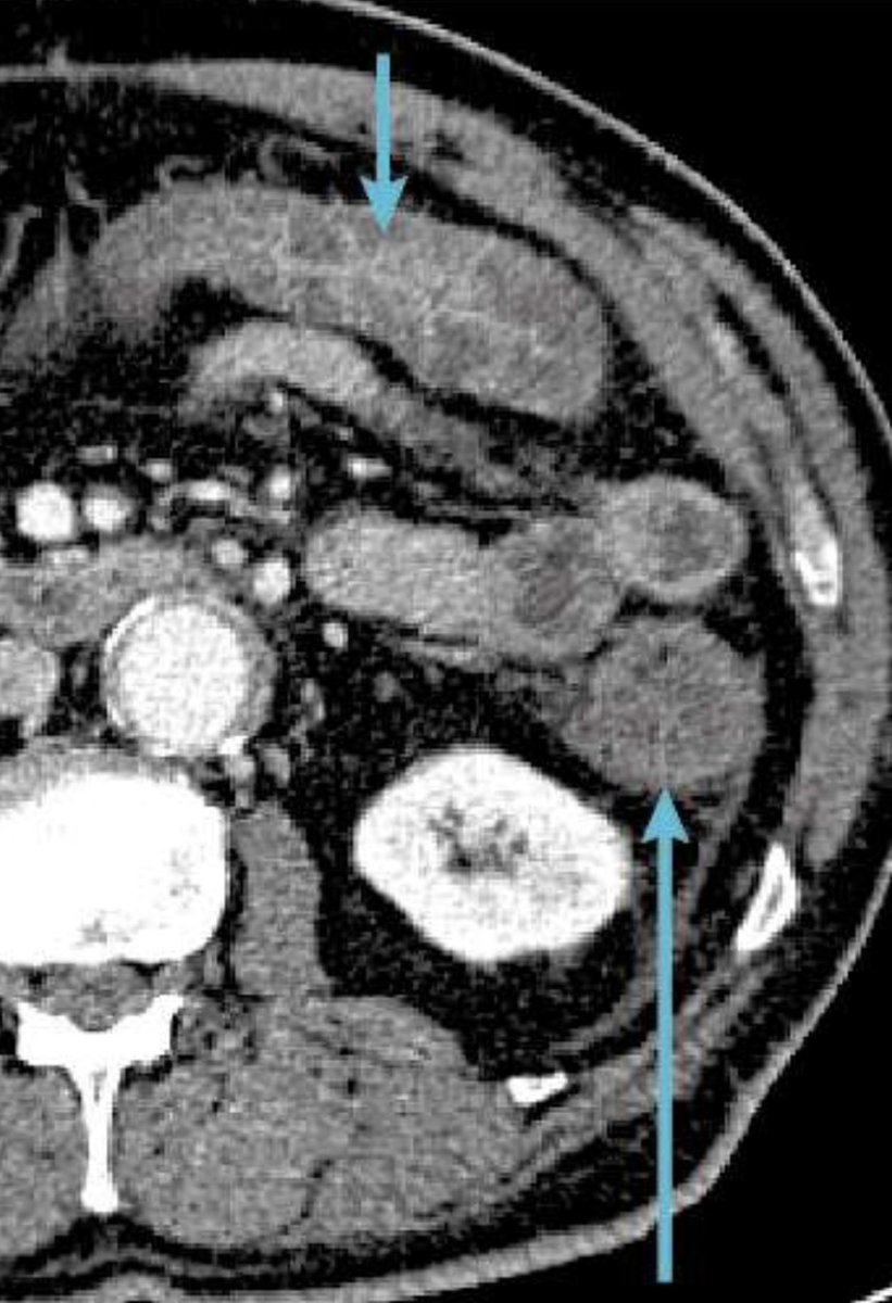 ScottRSteeleMD's tweet photo. #quickcase mid 50s otherwise healthy non smoking patient with history of colitis of unknown origin with splenic flexure stricture and residual inflammation in distal transverse colon. Failed dilation and unable to clear right side. What now? https://t.co/VilhumRwv1