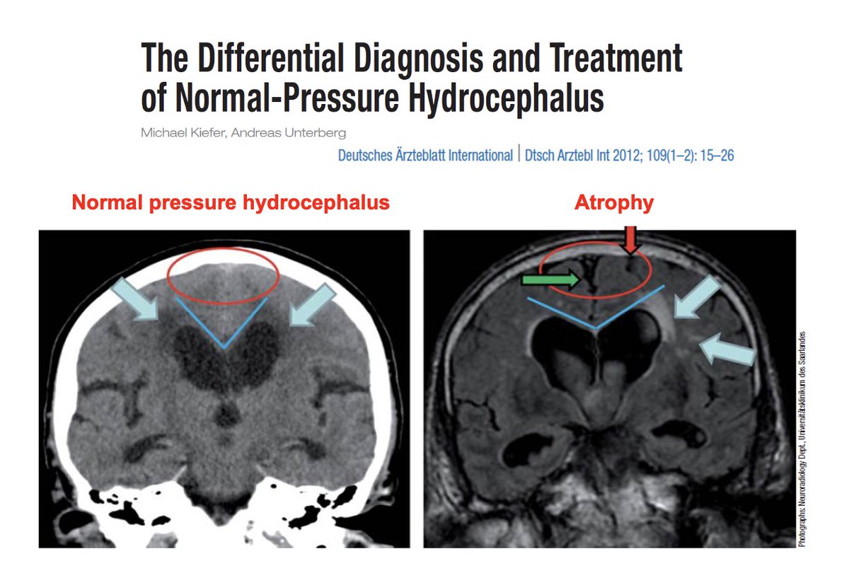MichaelOkun's tweet photo. Use all the clues available to decide whether or not someone has NPH. Love this picture of the atrophy pattern which may be a clue. The most critical aspect of management of potential NPH is to be thoughtful, use all the data, think about levodopa challenge if appropriate, and employ a diverse team to decide on optimal management. @movedisorder Aspen Gait Disorders review this AM.