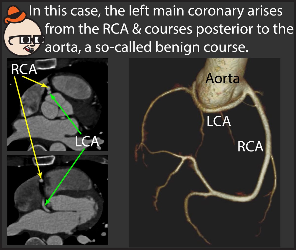 StefanTigges's tweet photo. 2/5 This week, we’ll learn about coronary artery anomalies. Here’s a harmless anomaly. If you’d like to learn how to read Chest X-rays, check out my free online interactive comic: https://t.co/xhAMW41QCh https://t.co/PP7cFQSpjd